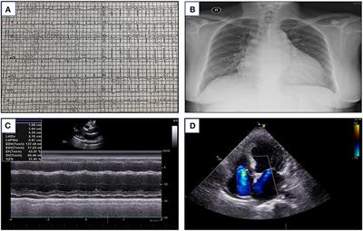 Hypocalcemic cardiomyopathy: A case report